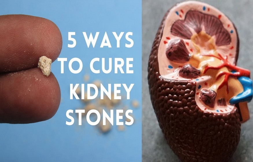 Remove Kidney Stones