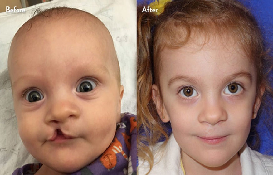 Cleft Lip And Palate Surgeries